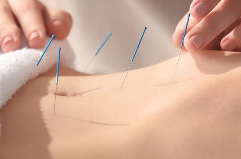 Prova l’acupuntura, el teu cos millorarà!
